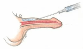 Hyaluronzuur injecties